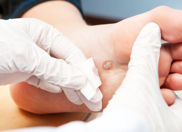 MBC Medical Göteborg vårta behandling 3