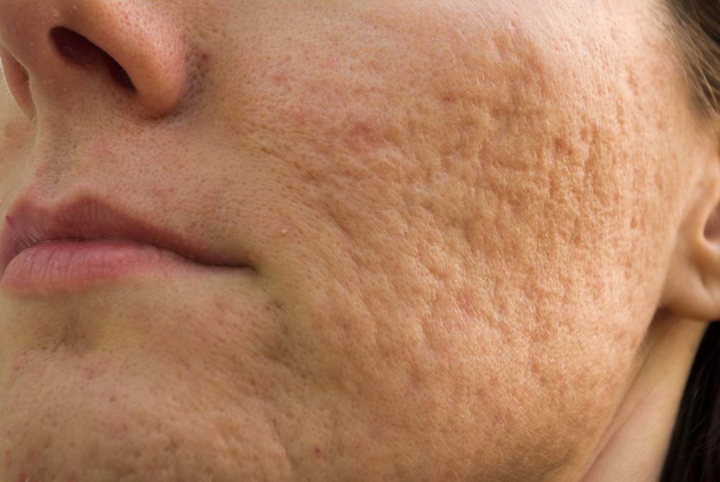 Behandla ärr från acne